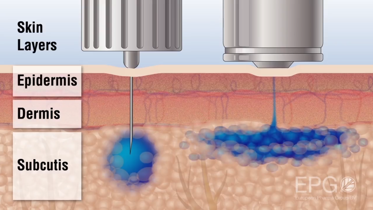 InsuJet™ | Needle-Free Insulin Injector for Diabetes Management