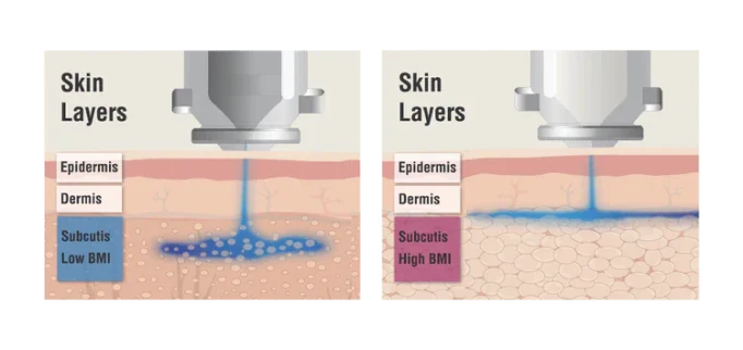The Science Behind InsuJet™